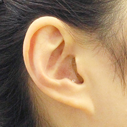 小型耳穴型補聴器CICの装着状態