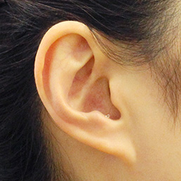 小型耳穴型補聴器IICの装着状態